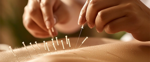 Accupunture